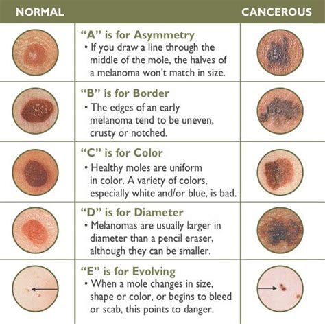 How Many Types Of Skin Cancer Cancerwalls