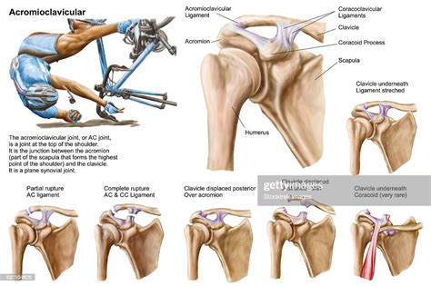 Anatomy Of Acromioclavicular Joint Rupture And Displacement