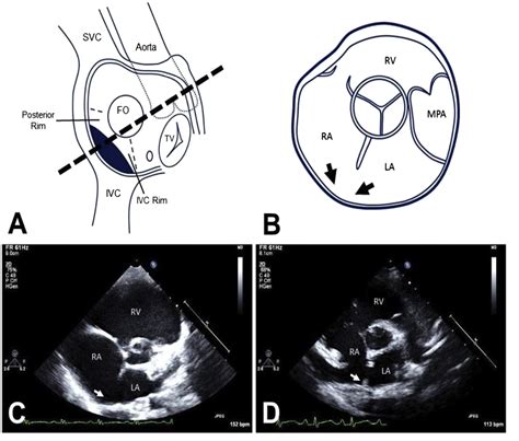 Figure 1 From The Parasternal Short‐axis View Improves Diagnostic