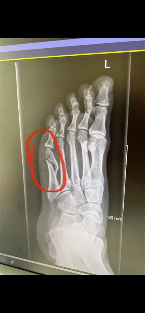 Coleen Rooney Shares X Ray Of Broken Foot After Rebekah Vardy Comments Metro News