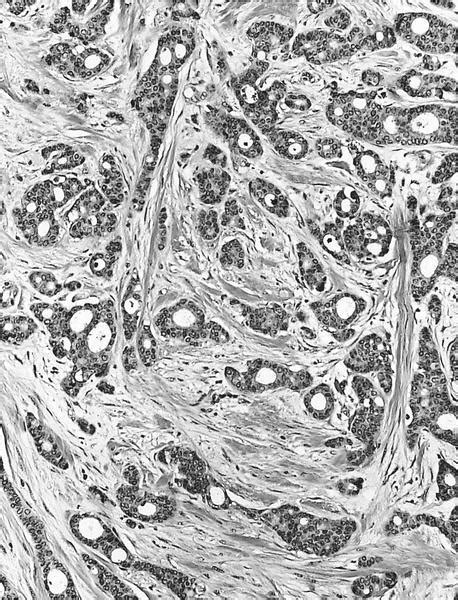 Pathology Outlines Histologic Grading