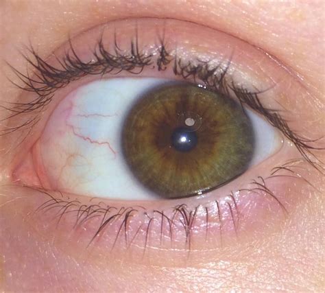 Central Heterochromia Green Eyes