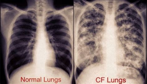 Cystic Fibrosis CF