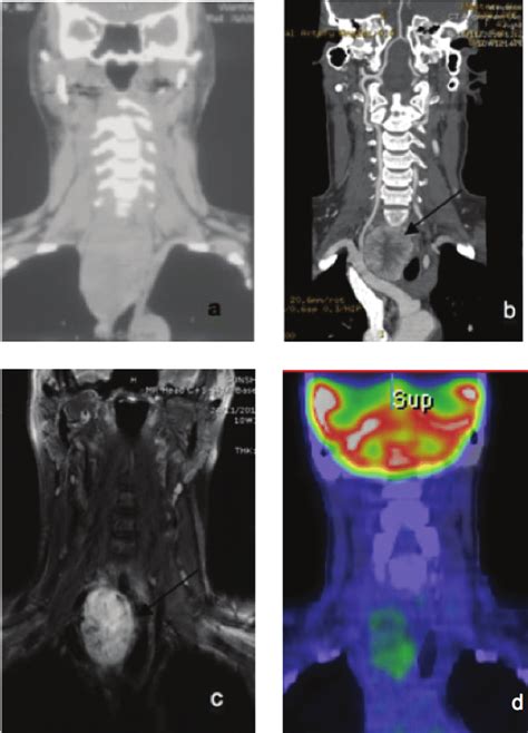 Neck Computed Tomography Ct Without Contrast A Showing Homogenous