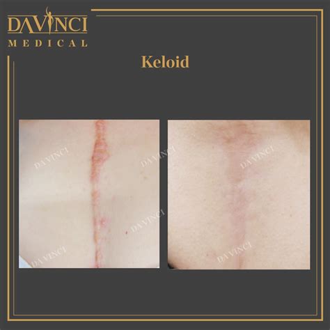 Da Vinci Clinic Keloid And Hypertrophic Scar Treatment