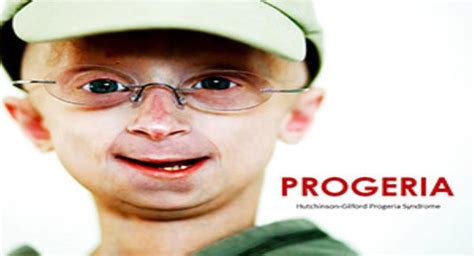Free Download Progeria Ppt Presentation Aging Disease Ppt