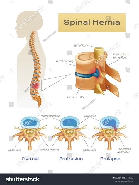 Vertebrae Spinal Cord Anatomy Infographics With Profile View Of My Xxx Hot Girl