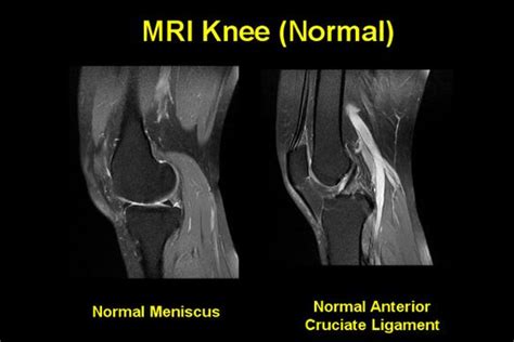 Scroll through the structures to understand the anatomy. MRI knee - Google Search | Anatomy - Imaging | Knee mri, Anatomy images, Sprain