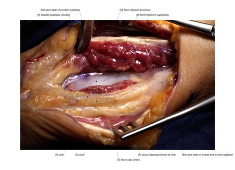 Anterior Interosseous To Ulnar Motor Supercharge Nerve Transfer