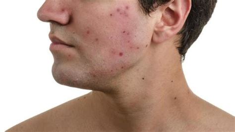 Guy With Alot Of Pimples