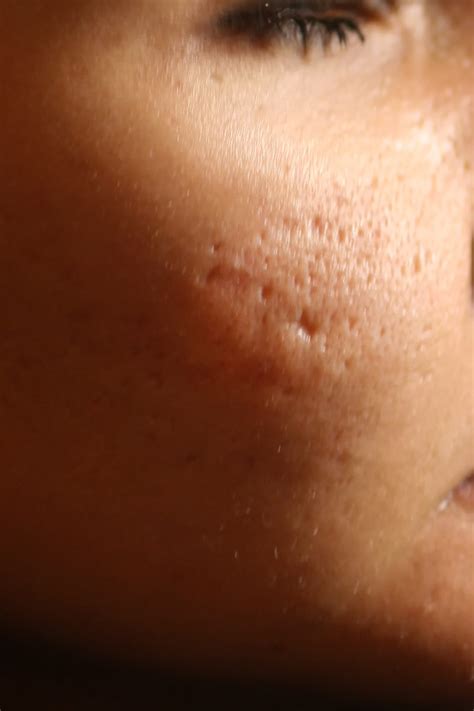 Types Of Acne Scars And How To Get Rid Of Them All