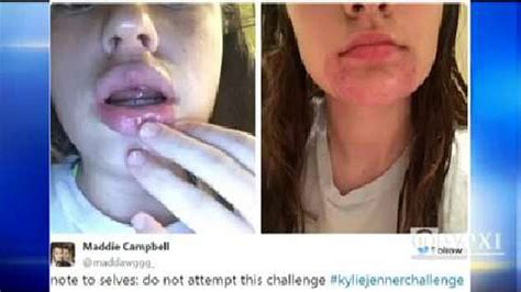 Disturbing Kyliejennerchallenge To Pump Lips Leaves Teens Faces