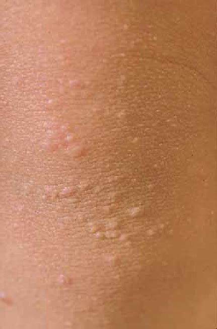 Papular Form Of Atopic Eczema Flat Papules On Exten Sor Aspect Of