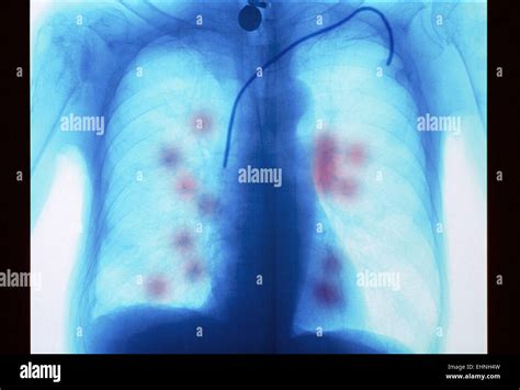 Secondary Lung Cancer Coloured X Ray Of A Patient With Metastatic