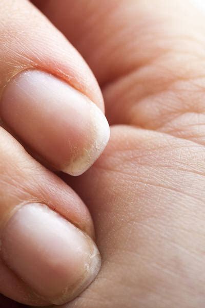 How Nail Biting Could Prove Harmful And Dangerous To Your Health Top