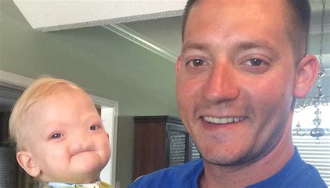Eli Thompson Alabamas Miracle Baby Born Without Nose Dies At 2