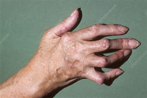 Rheumatoid Arthritis Of The Hand Stock Image C0292471 Science