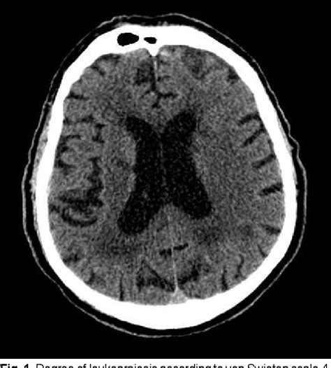 Figure 1 From Cerebral Small Vessel Disease And Its Impact On The
