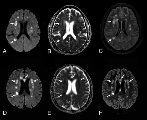 Unusual Brain Mri Pattern In 2 Patients With Covid 19 Acute Respiratory