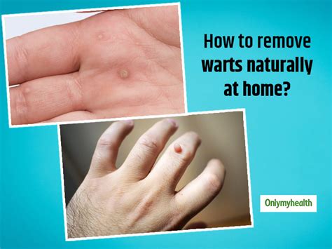 The Best Strategy To Use For Worrisome Warts Try These 7 Home Remedies