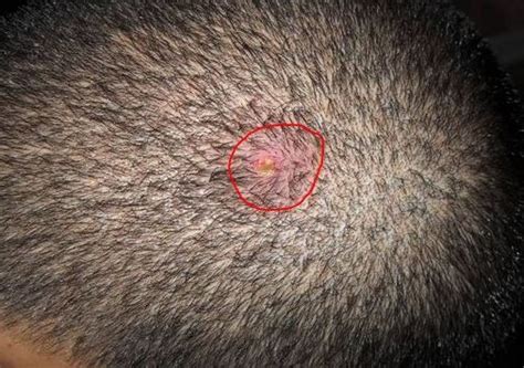 Pimple Like Bump On Scalp Image Pimples On Scalp Pimples Redness