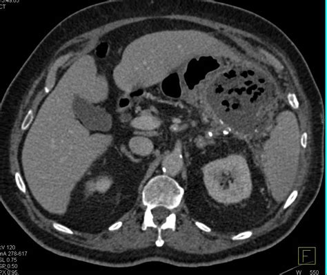 Pancreatic Abscess Extends To The Stomach Pancreas Case Studies