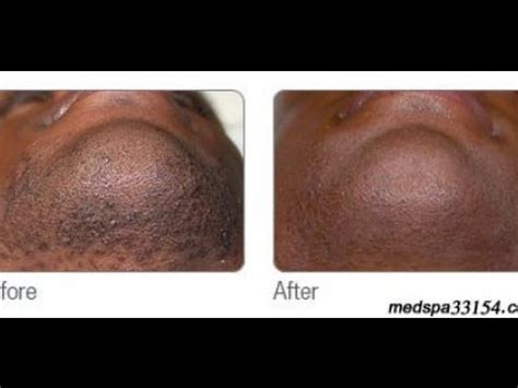 And let's clear up a misconception some guys just have really hairy butts, too. Laser Hair Removal in Miami for Black Men - YouTube