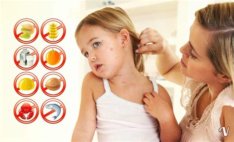 Un'allergia alimentare è una reazione del sistema immunitario verso uno specifico alimento; Allergie alimentari: sintomi, cause e diagnosi di un'allergia