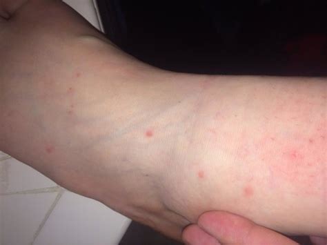 Bed Bugs Bites All Over My Feet And Legs Picture Of Holiday Inn