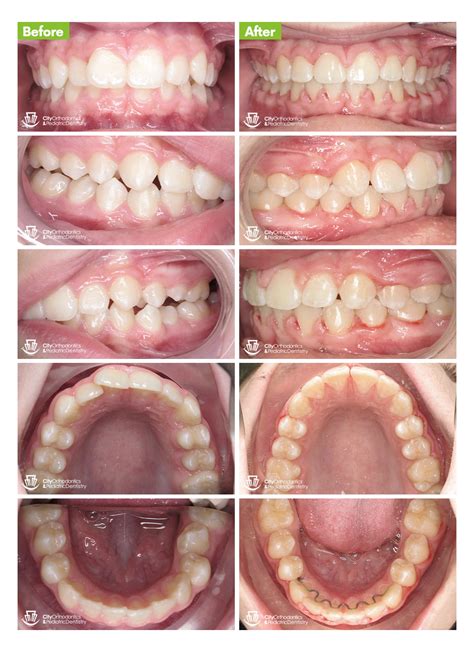 Overbite 1 Before And After Smile Gallery Edmonton