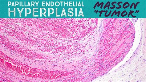 Masson Tumor Organizing Thrombus And Papillary Endothelial Hyperplasia