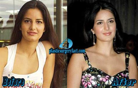 Katrina Kaif Plastic Surgery Before And After Photos Lip Fillers Celebrity Plastic Surgery