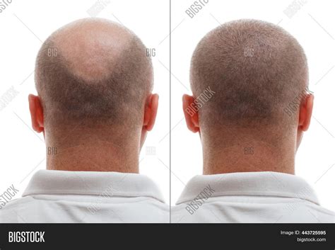 Head Balding Man Image And Photo Free Trial Bigstock