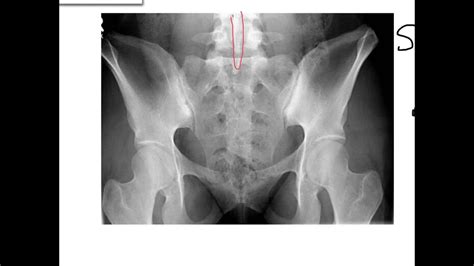 Sacrum Coccyx And Si Joints Youtube