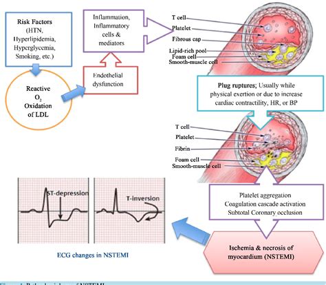 Acs (stemi or ua/nstemi) & planned pci. Figure 1 from Routine Primary PCI; Whether and When ...