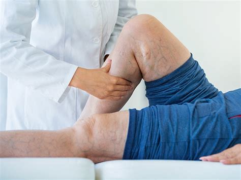 Deep Vein Thrombosis Definition Symptoms And Treatment