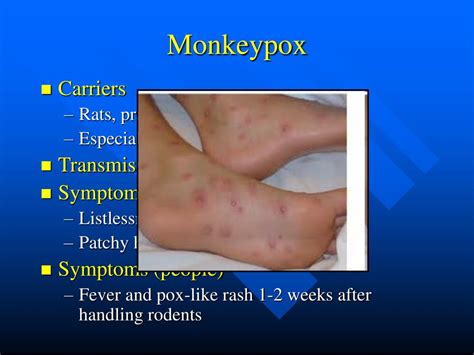 Monkeypox Treatment How To Prevent Monkeypox 7 Steps With Pictures