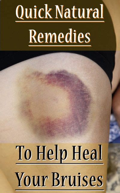 Quick Natural Remedies To Help Heal Your Bruises Heal Bruises