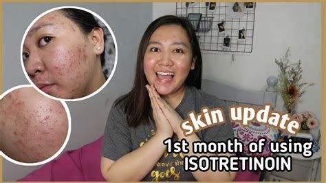 Skin Update ♡ 1st Month Of My Isotretinoin Journey Youtube