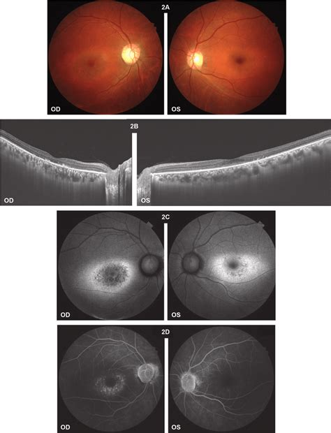 A Color Fundus Photographs Showing Macular Mottling B Macular Oct