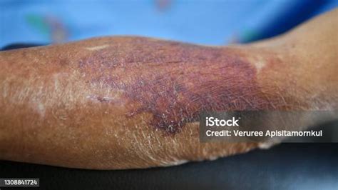 Large Bruise On Senior People Arm Stock Photo Download Image Now