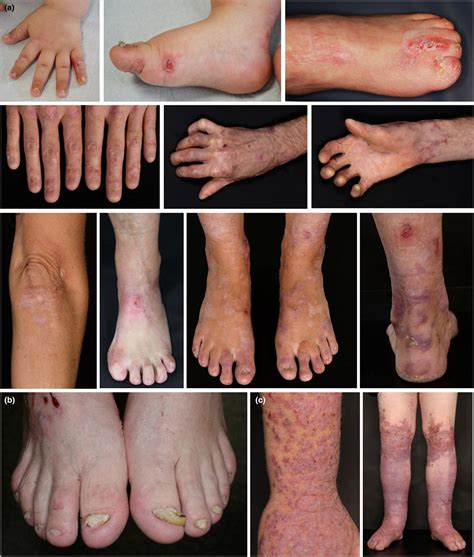 Consensus Reclassification Of Inherited Epidermolysis Bullosa And Other