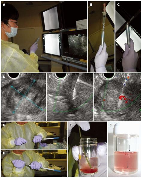 Endoscopic Ultrasonography Guided Fine Needle Aspiration For The