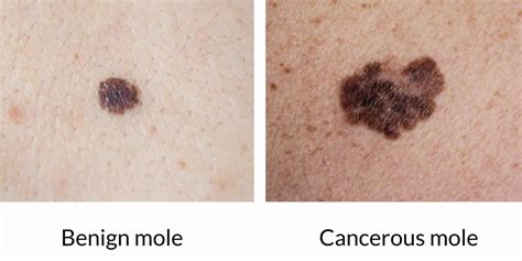 The Mole Guide What Does A Cancerous Mole Look Like Harley Medical Group