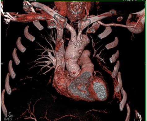 Mediastinal Abscess With Air Fluid Levels Chest Case Studies Ctisus