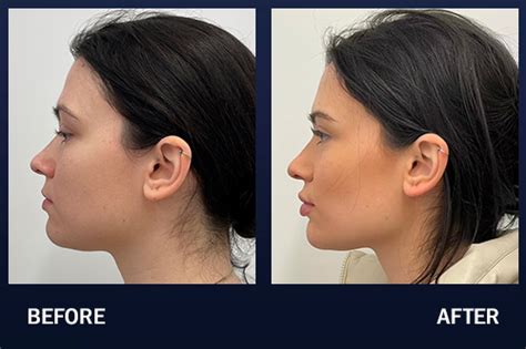 Jawline Contouring Before After Pictures Madnani Facial Plastic Surgery