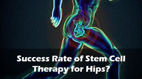 Success Rate Of Stem Cell Therapy For Hips Centeno Schultz