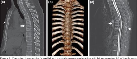 Figure 1 From Multiple Thoracic Vertebral Fractures As A Complication