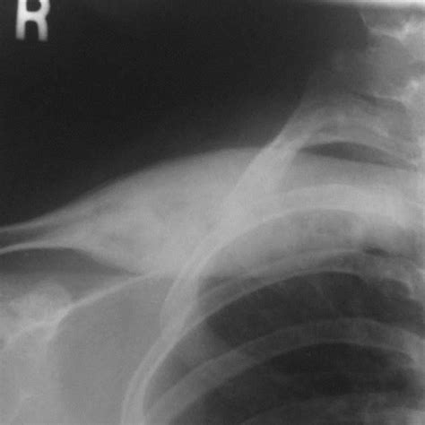 Pdf Non Bacterial Chronic Recurrent Osteomyelitis Of The Clavicle