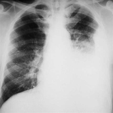 Chest X Ray 1a Showed Left Lower Lobe Lung Nodule Ct Scan 1b Images